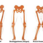 Knee Valgus