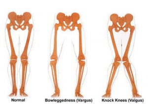 Knee Valgus