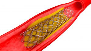 heart stent 2