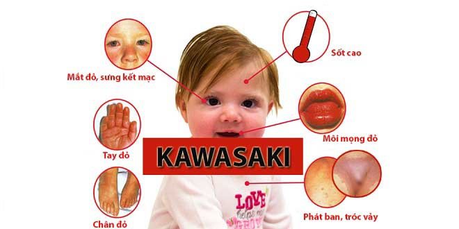 bệnh kawasaki ở trẻ em