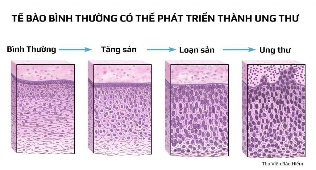 Loạn sản